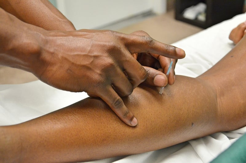 Acupuncture Benefits