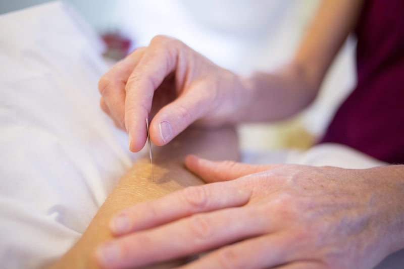 Acupuncture needles